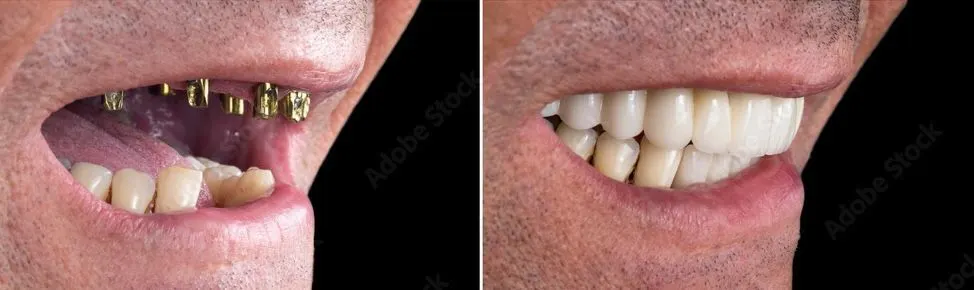Dental Implants | East Ellijay, GA before and after
