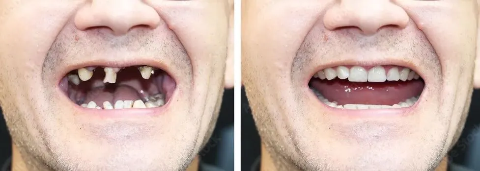Dental Implants before and after