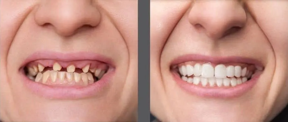 Dental Implants | East Ellijay, GA before and after