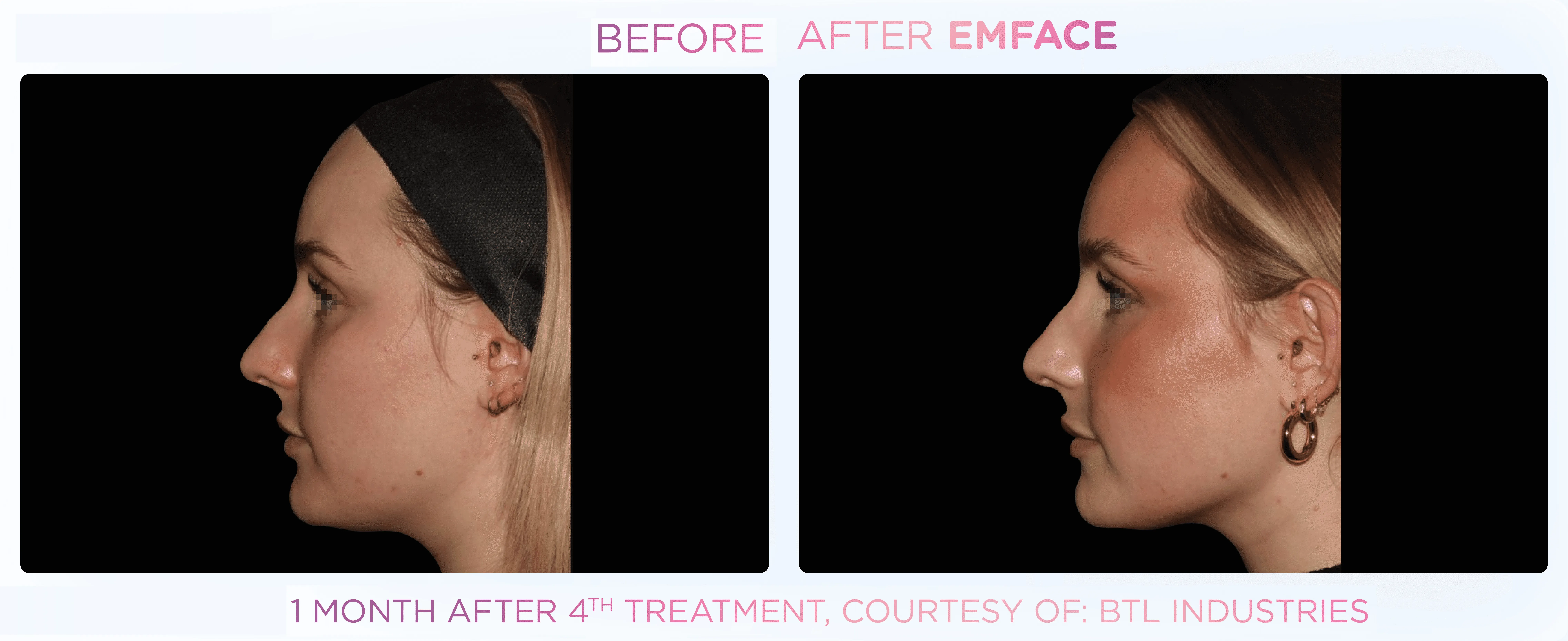 Emface | East Ellijay, GA before and after