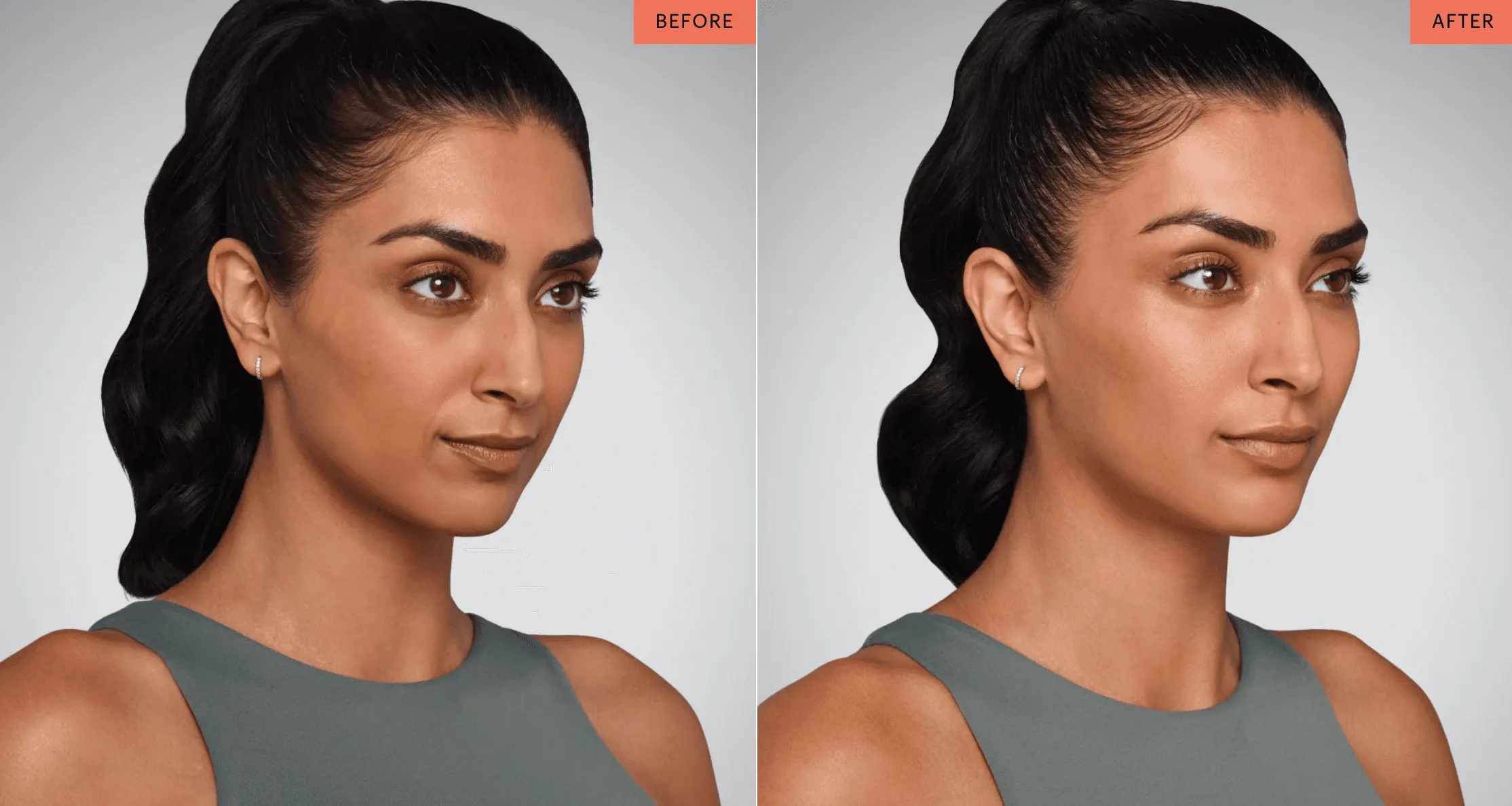 Juvederm before and after