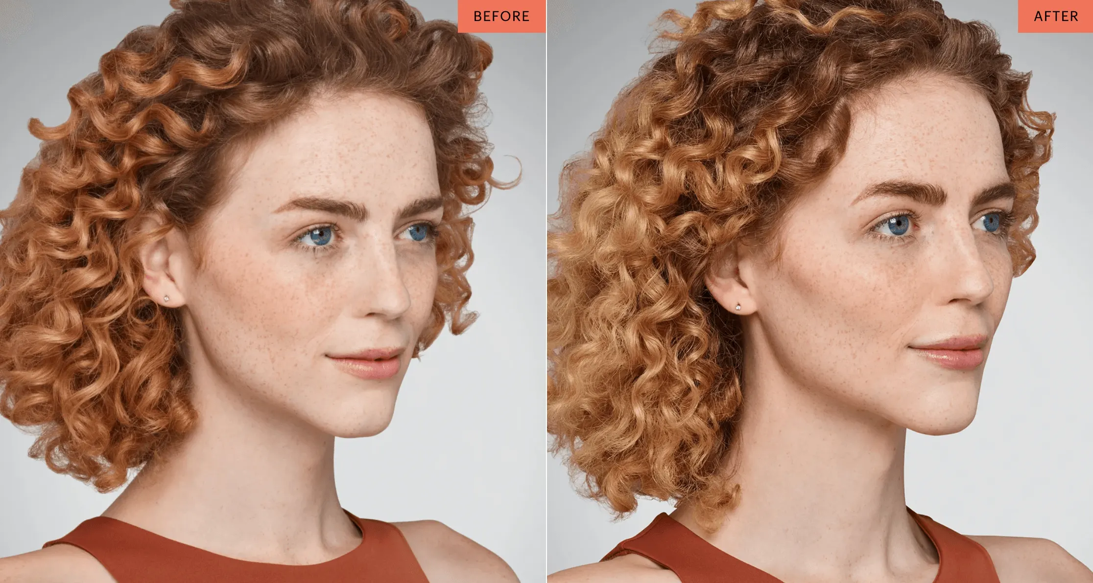 Juvederm | East Ellijay, GA before and after