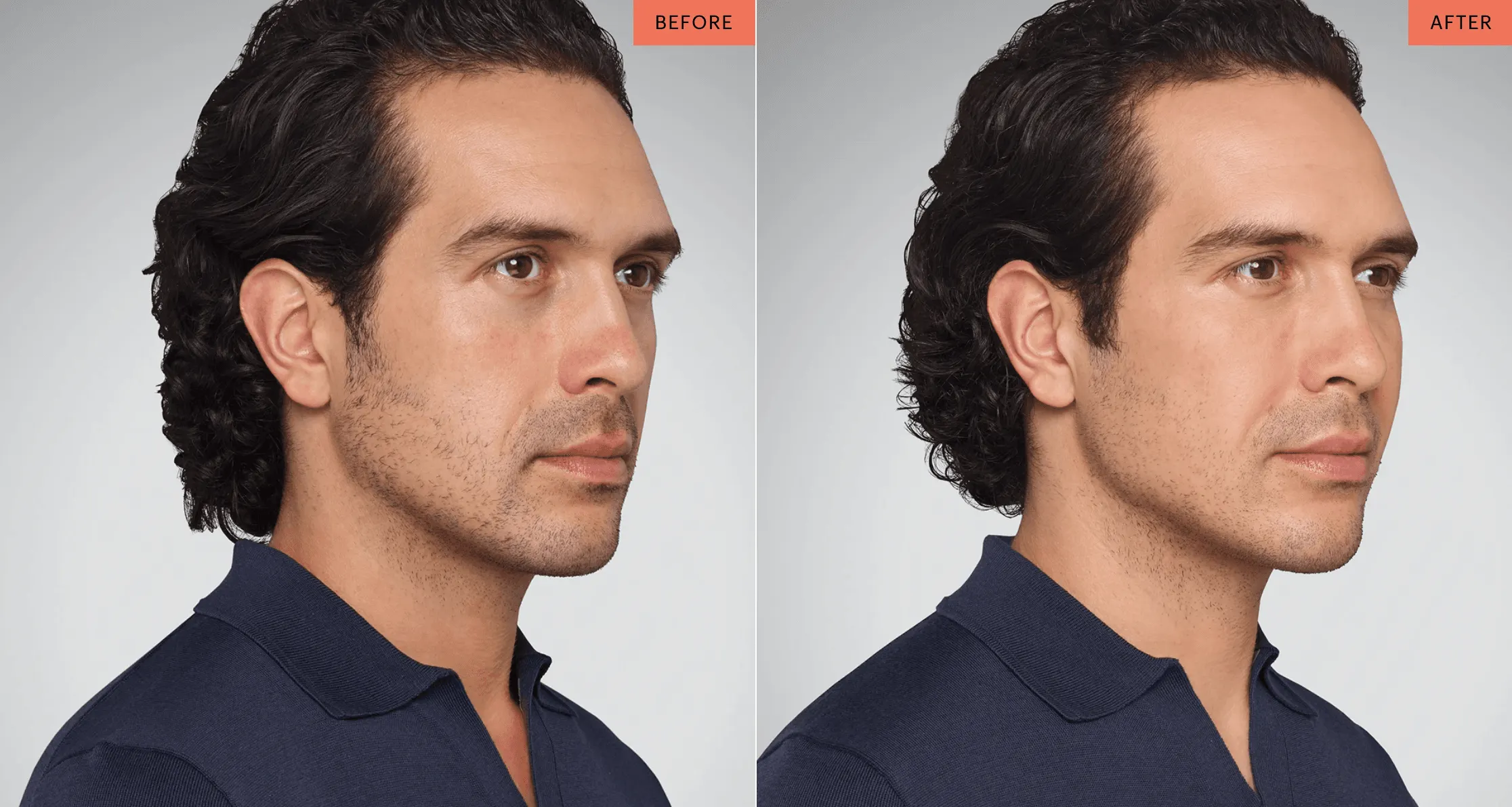 Juvederm | East Ellijay, GA before and after