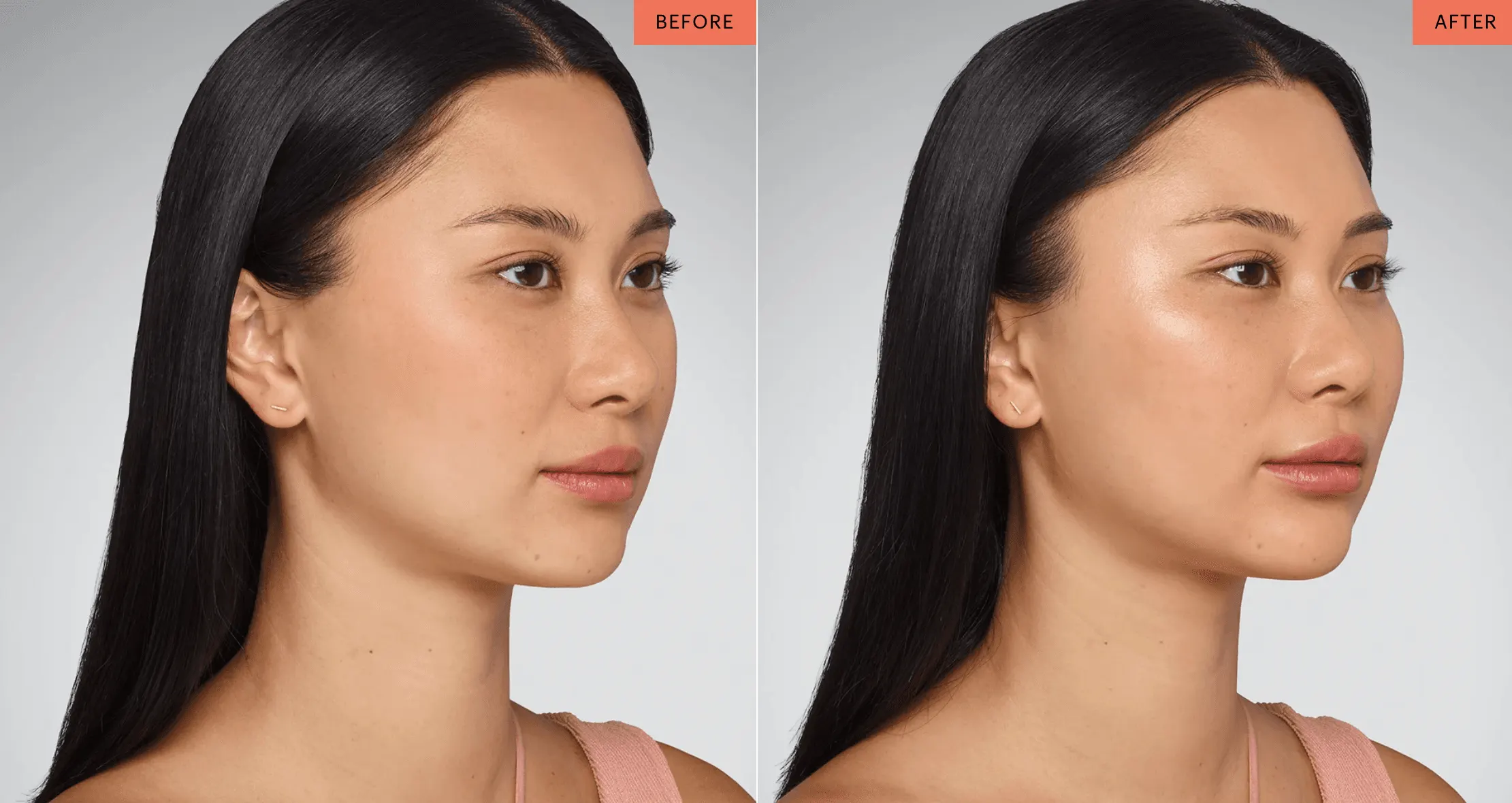 Juvederm | East Ellijay, GA before and after