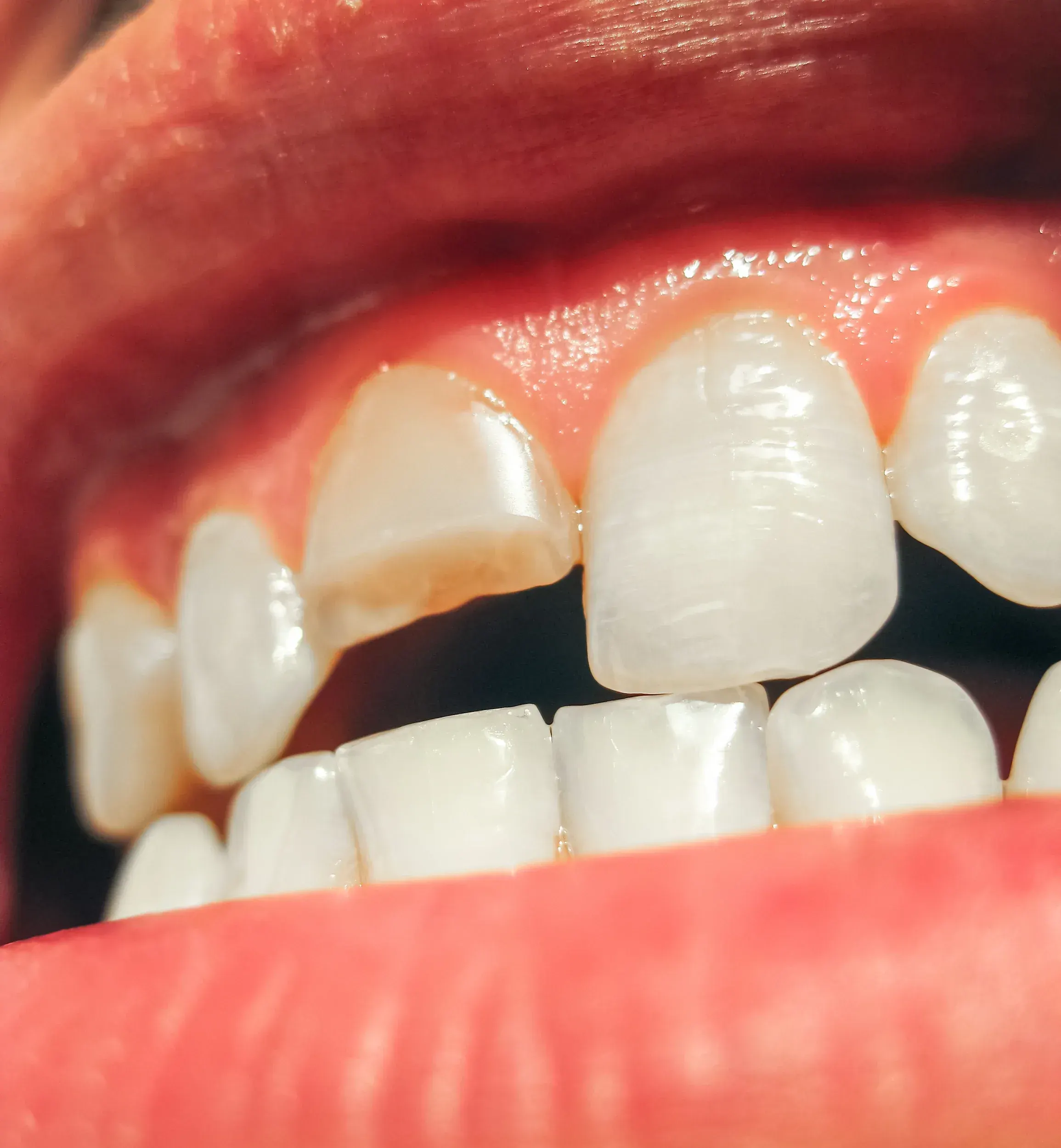 Illustration of enamel fracture progression at East Ellijay Family & Cosmetic Dentistry Ellijay