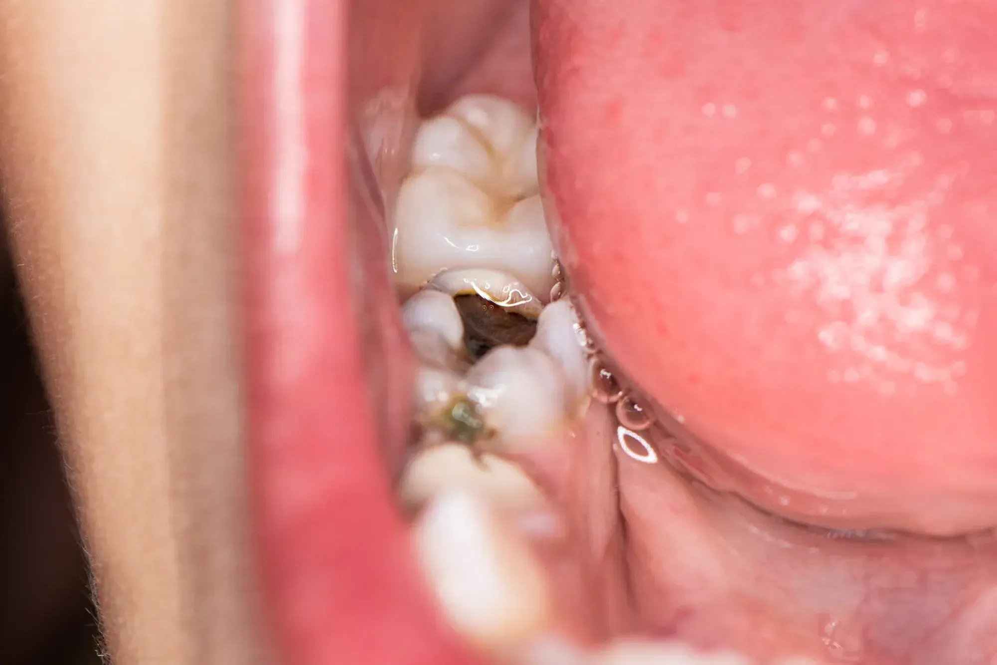 Illustration showing acid demineralization of enamel at East Ellijay Family and Cosmetic Dentistry