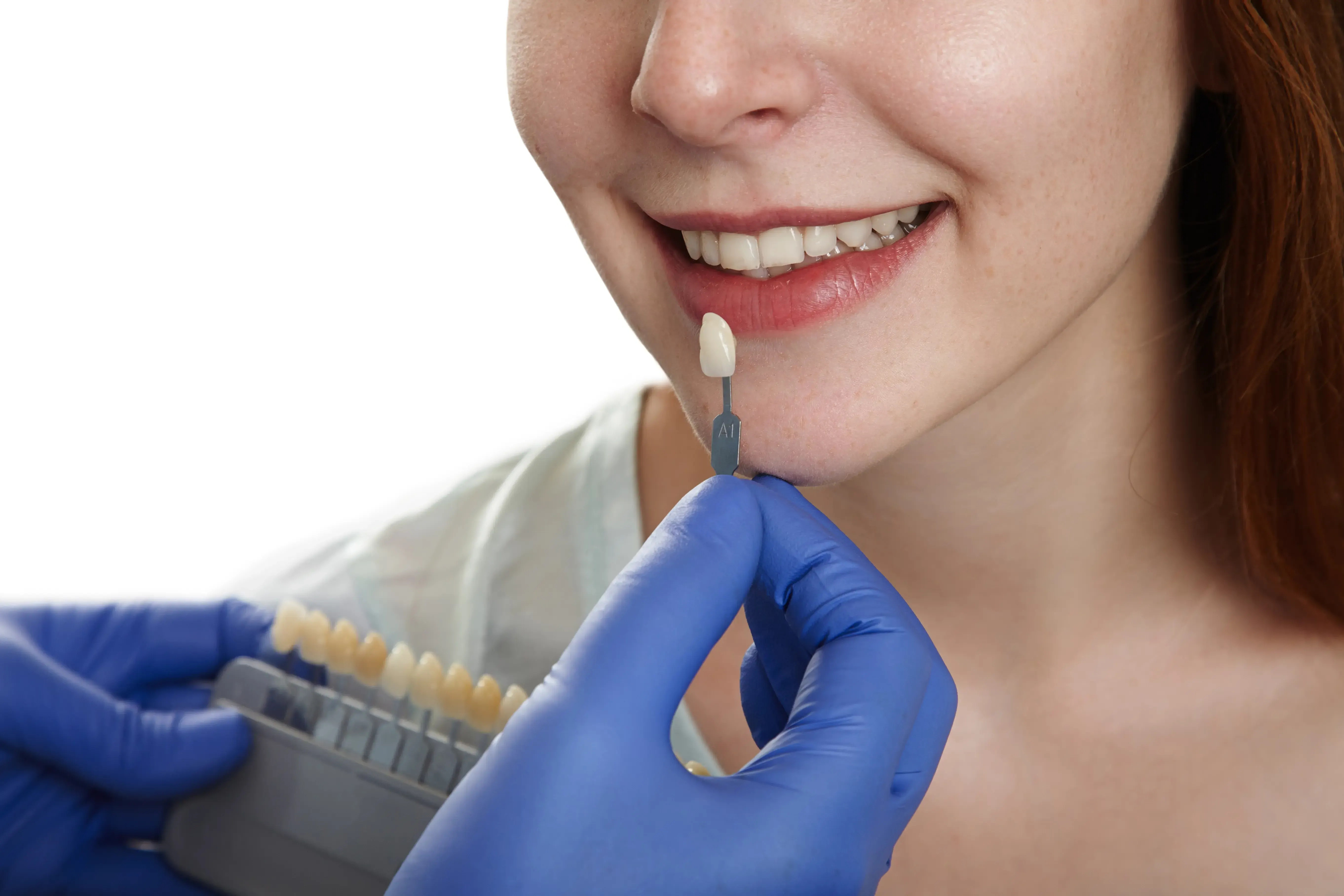 Caring for Your Dental Veneers