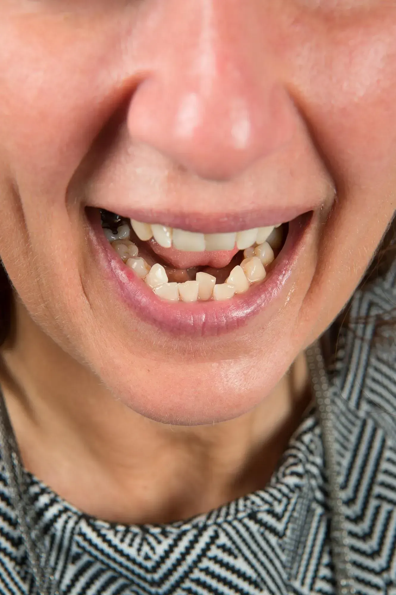Close-up of mildly crowded front teeth being evaluated for clear aligners at East Ellijay Family and Cosmetic Dentistry