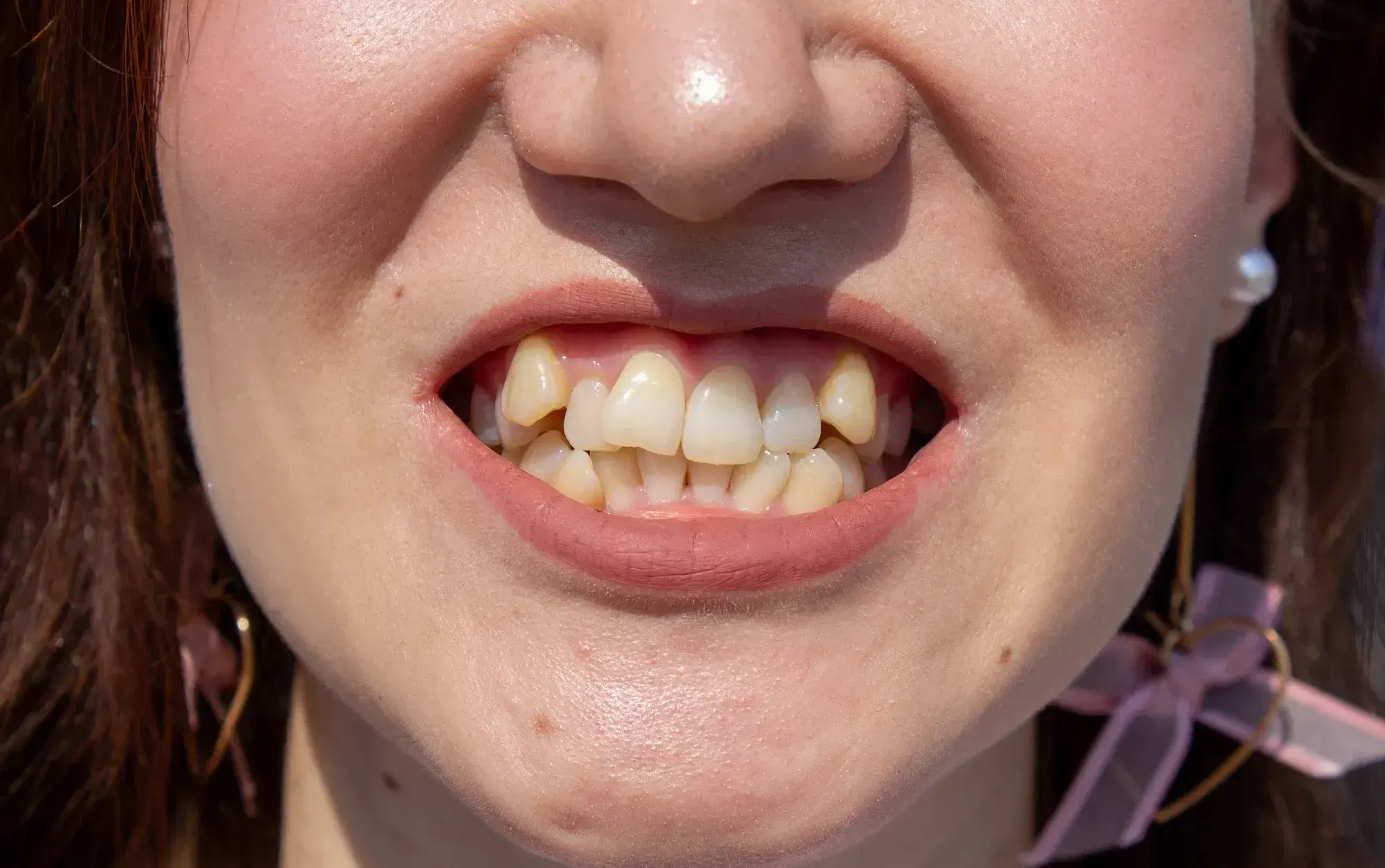Illustration showing crowded lower teeth and arch space comparison at East Ellijay Family and Cosmetic Dentistry East Ellijay GA