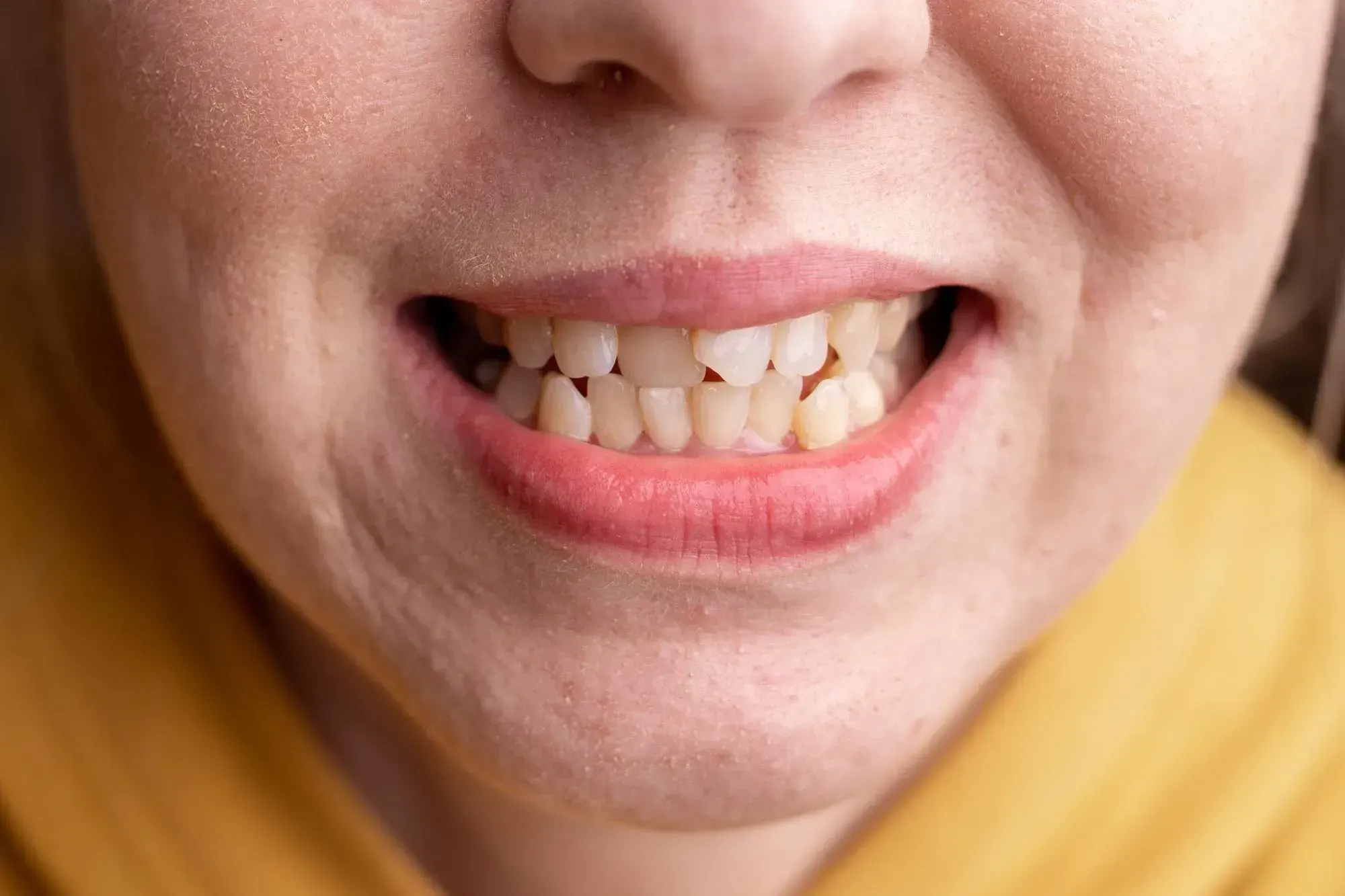 Adult smiling with straight teeth after Invisalign treatment at East Ellijay Family and Cosmetic Dentistry in East Ellijay GA