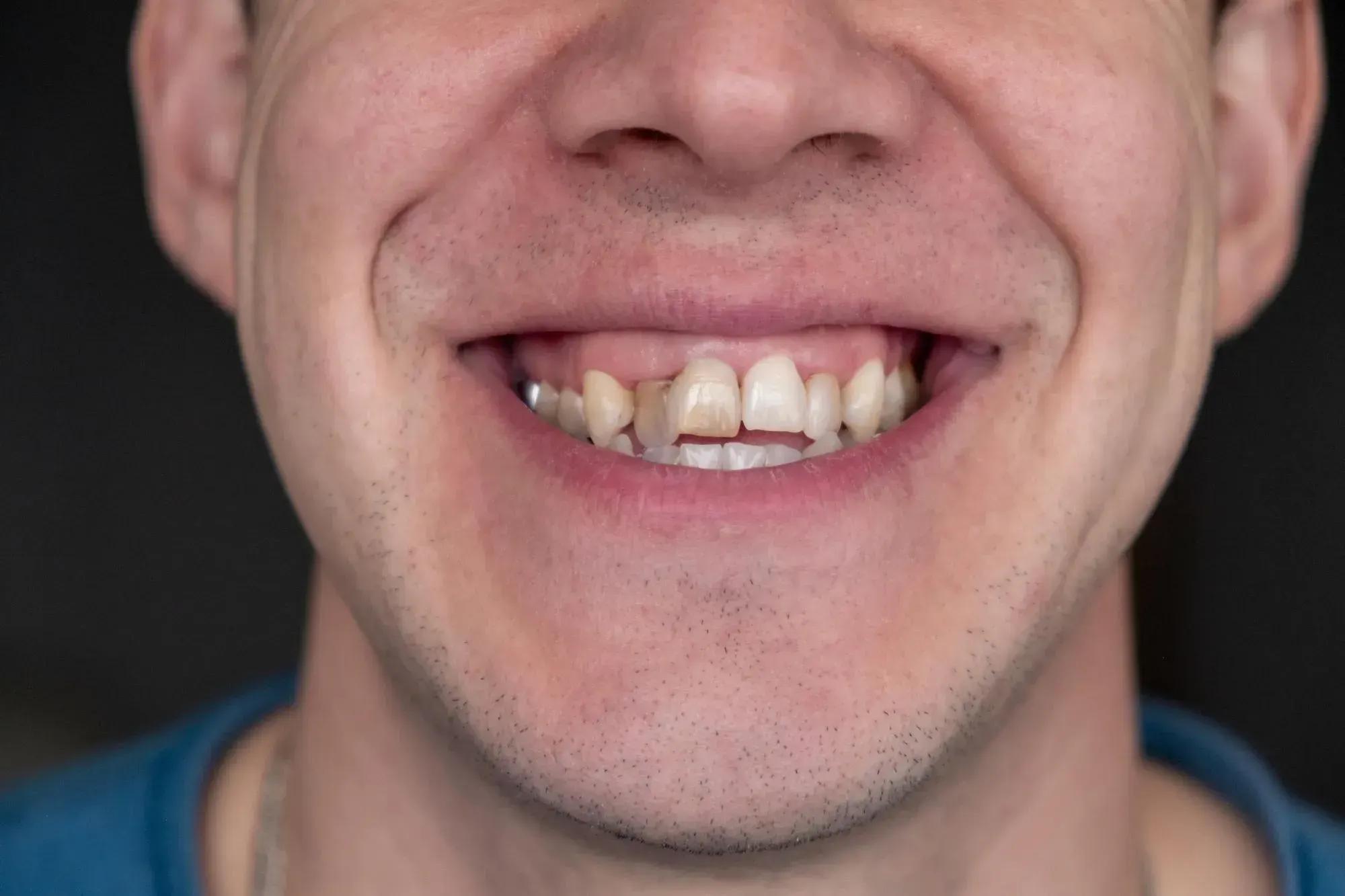 Bite analysis using 3D digital dental scanner at East Ellijay Family and Cosmetic Dentistry East Ellijay GA