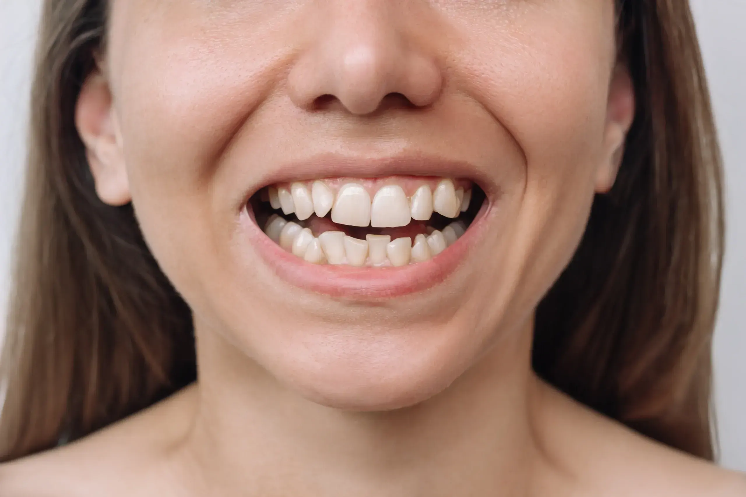 Adult patient consulting about crooked teeth at East Ellijay Family and Cosmetic Dentistry East Ellijay GA