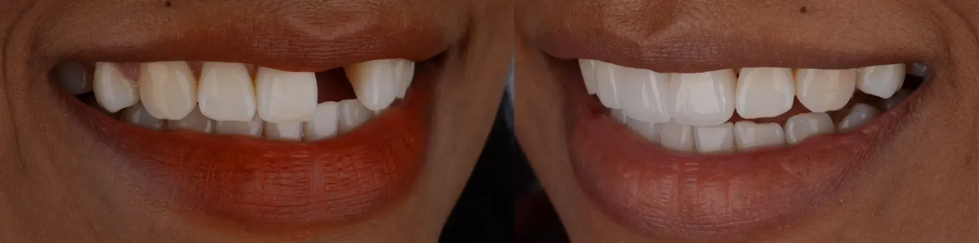 Dental Bridges | East Ellijay, GA