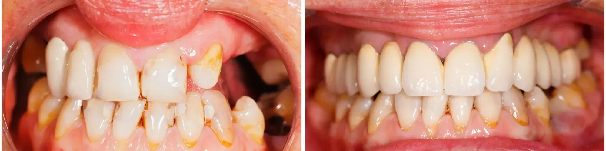 Dental Bridges | East Ellijay, GA before and after