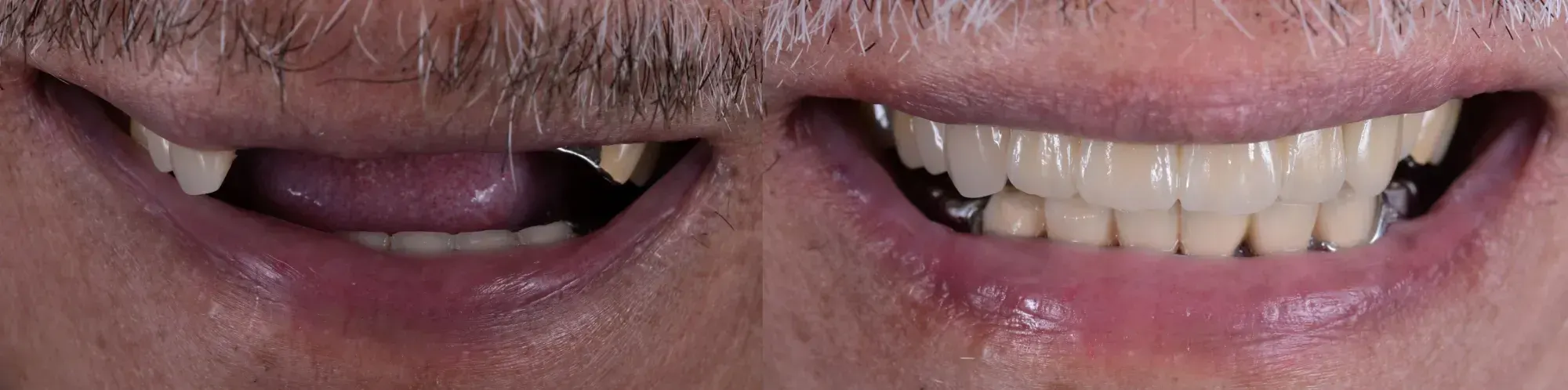 Dental Bridges before and after