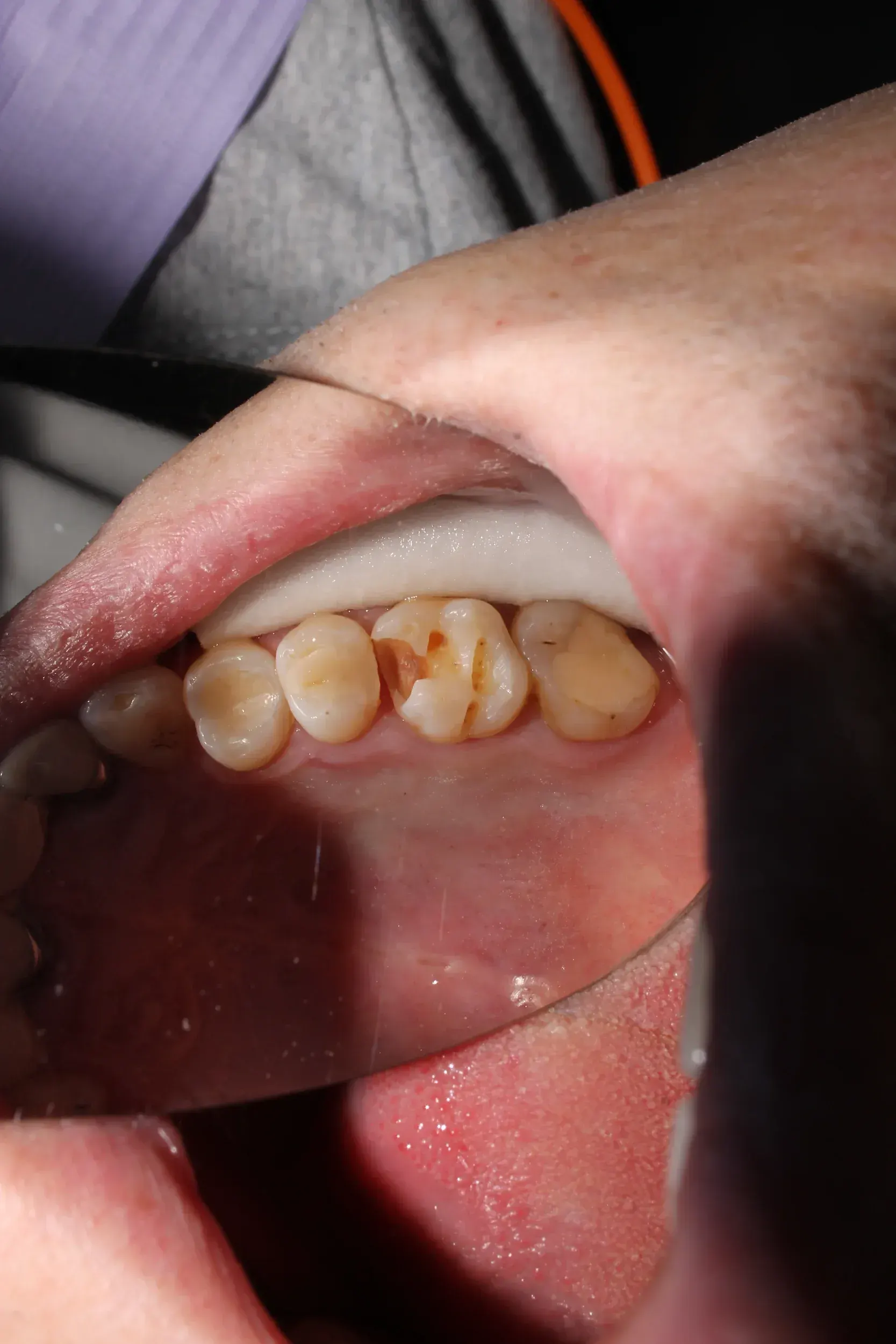 Diagram showing tooth anatomy and fracture layers at East Ellijay Family & Cosmetic Dentistry