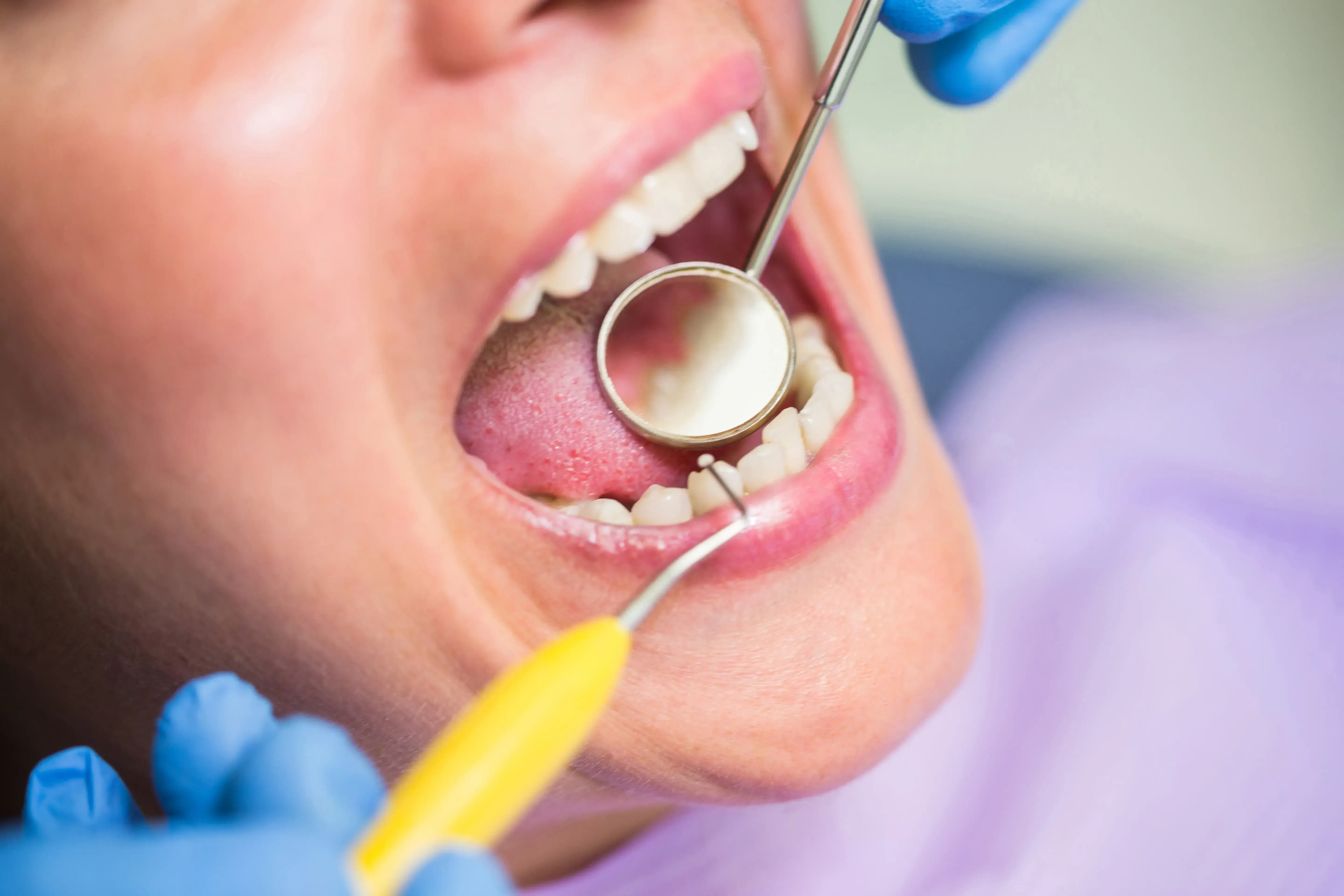Tooth-Colored Fillings Restore Damaged Teeth