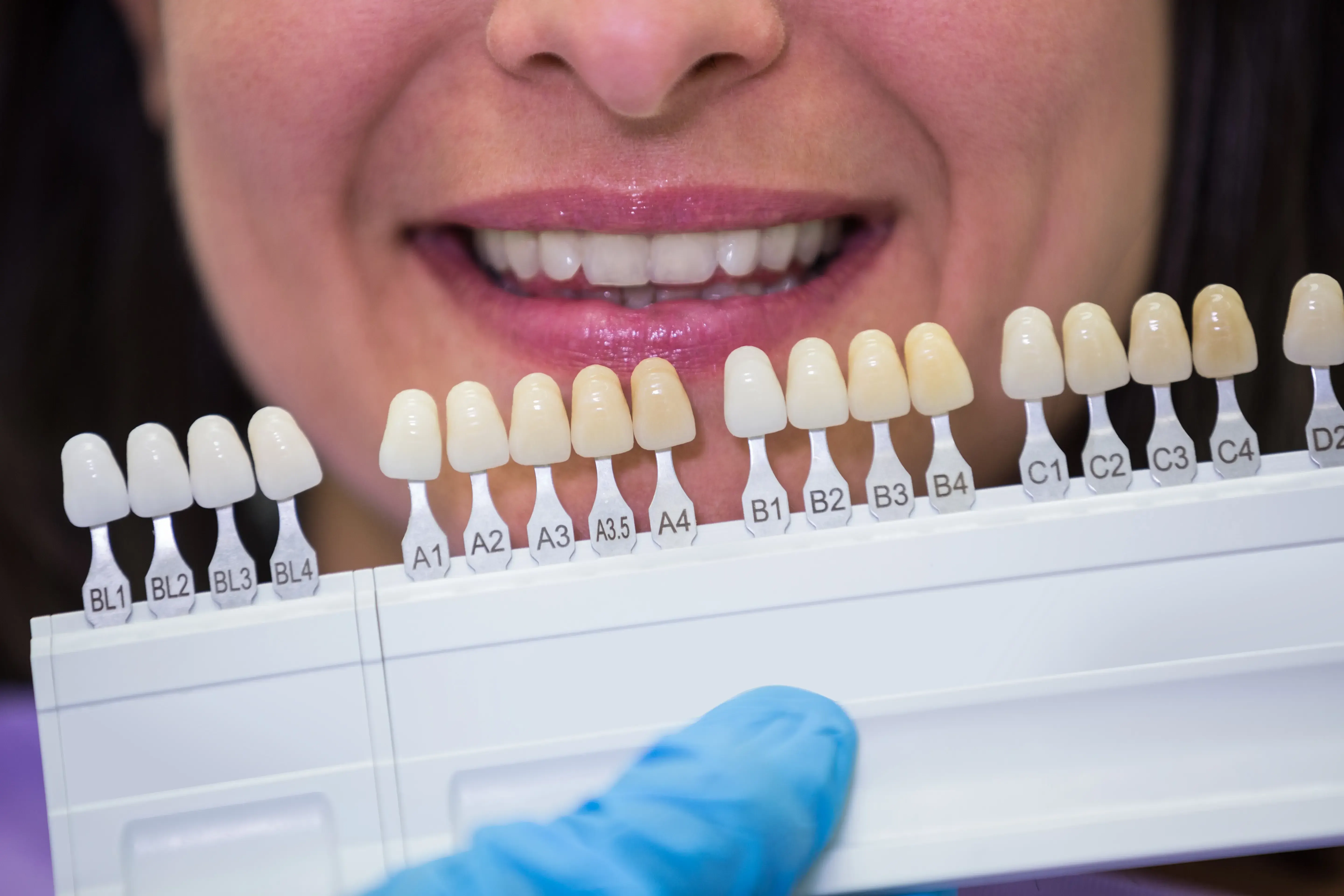 How Porcelain Veneers Can Improve Your Smile