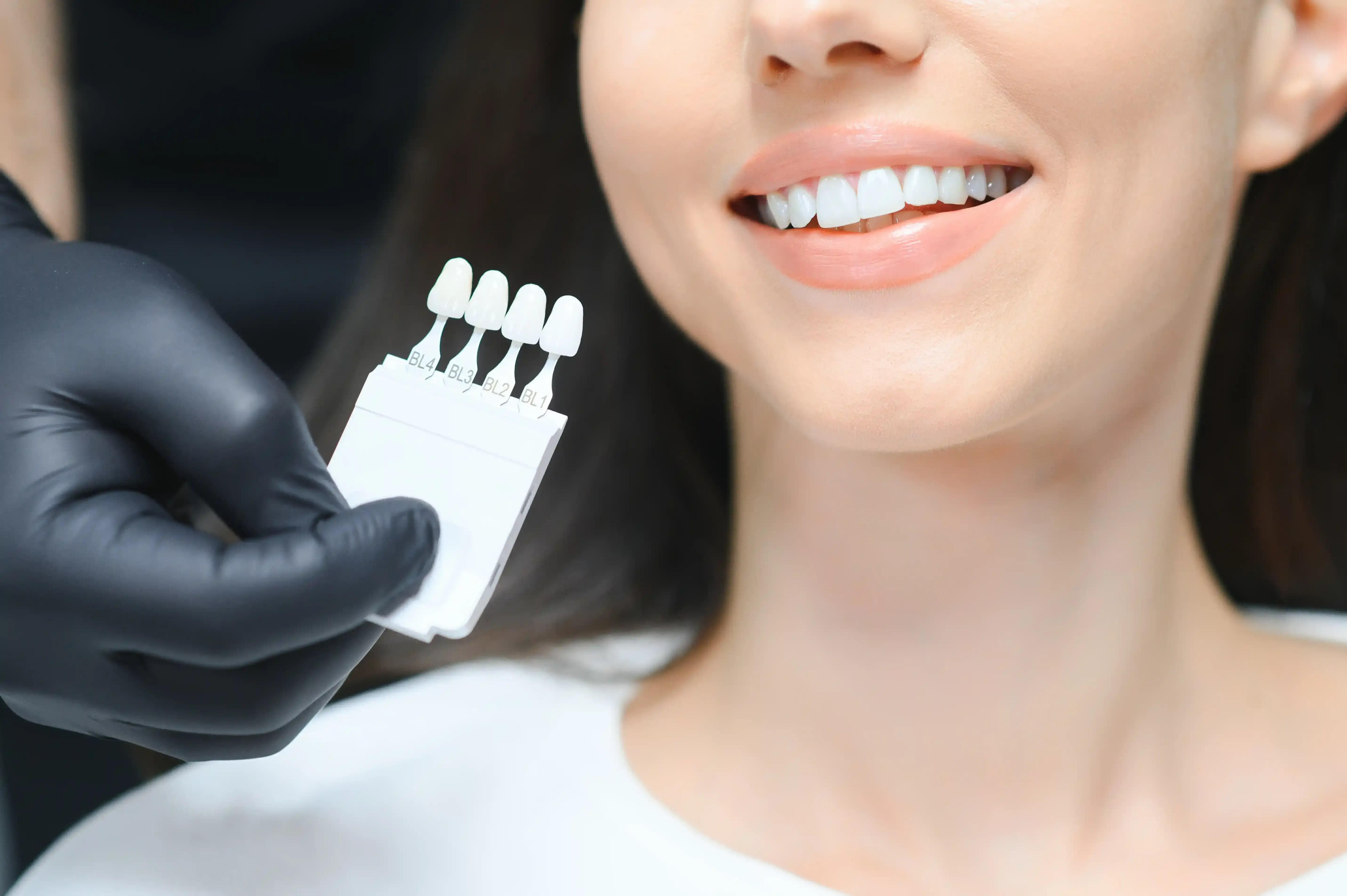 Are Veneers Permanent?