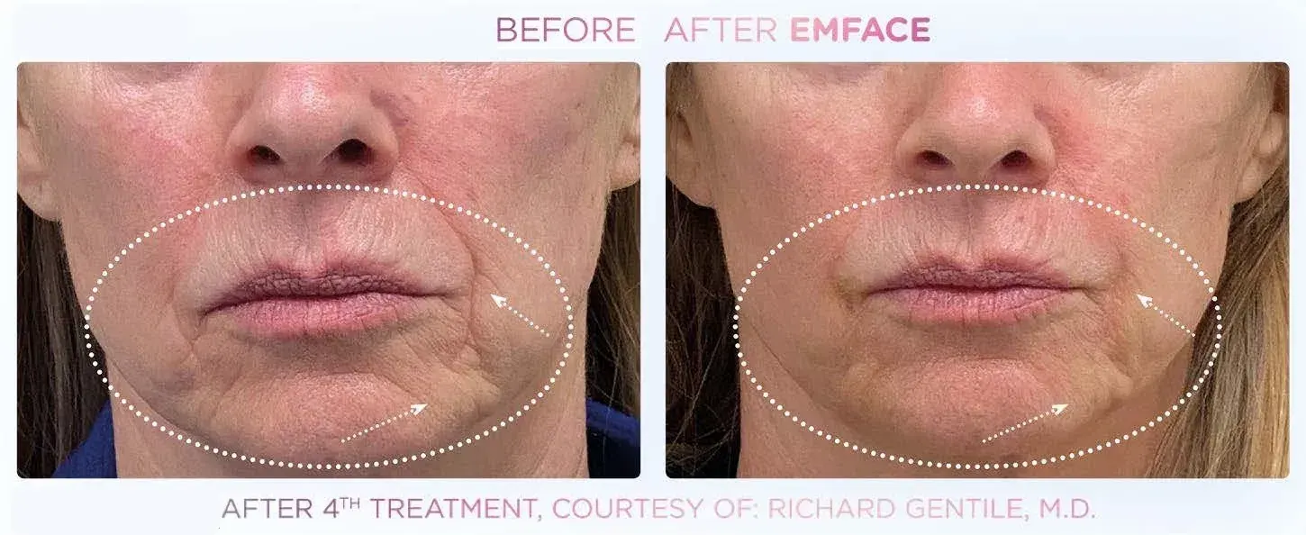 Emface | East Ellijay, GA before and after