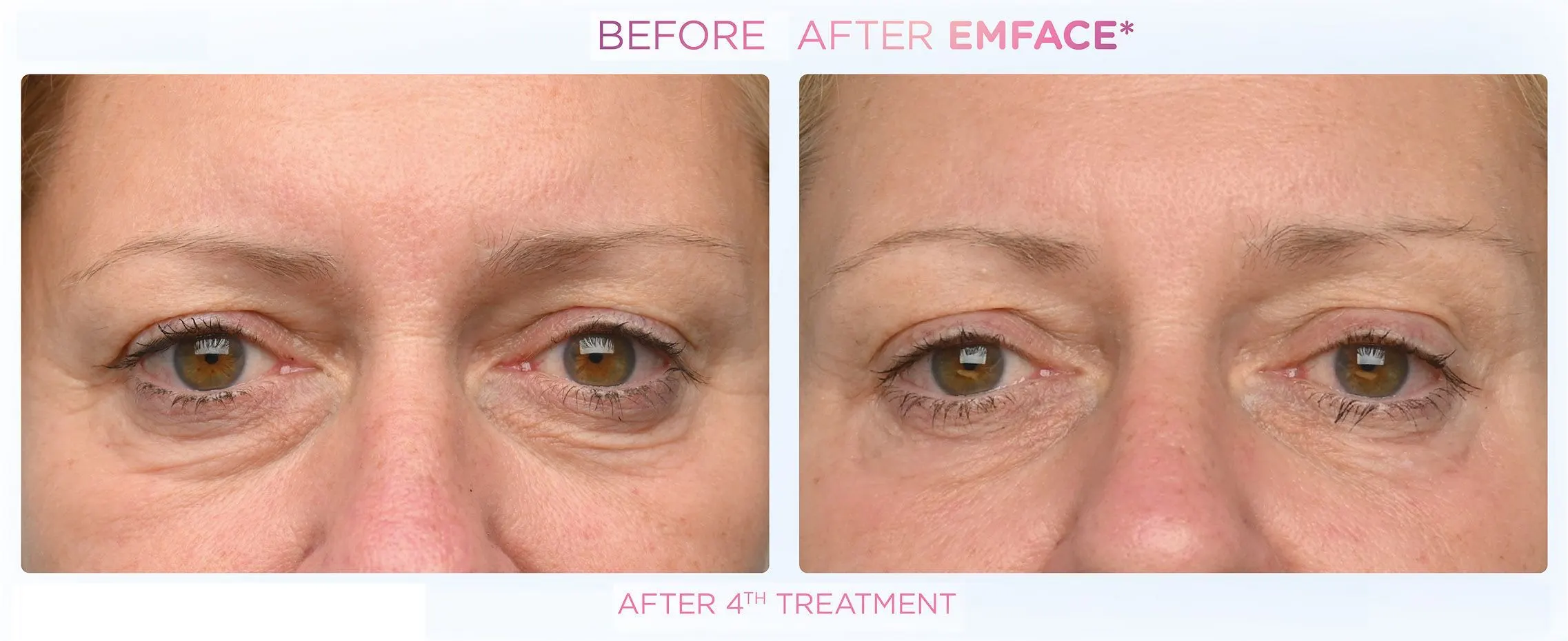 Emface | East Ellijay, GA before and after