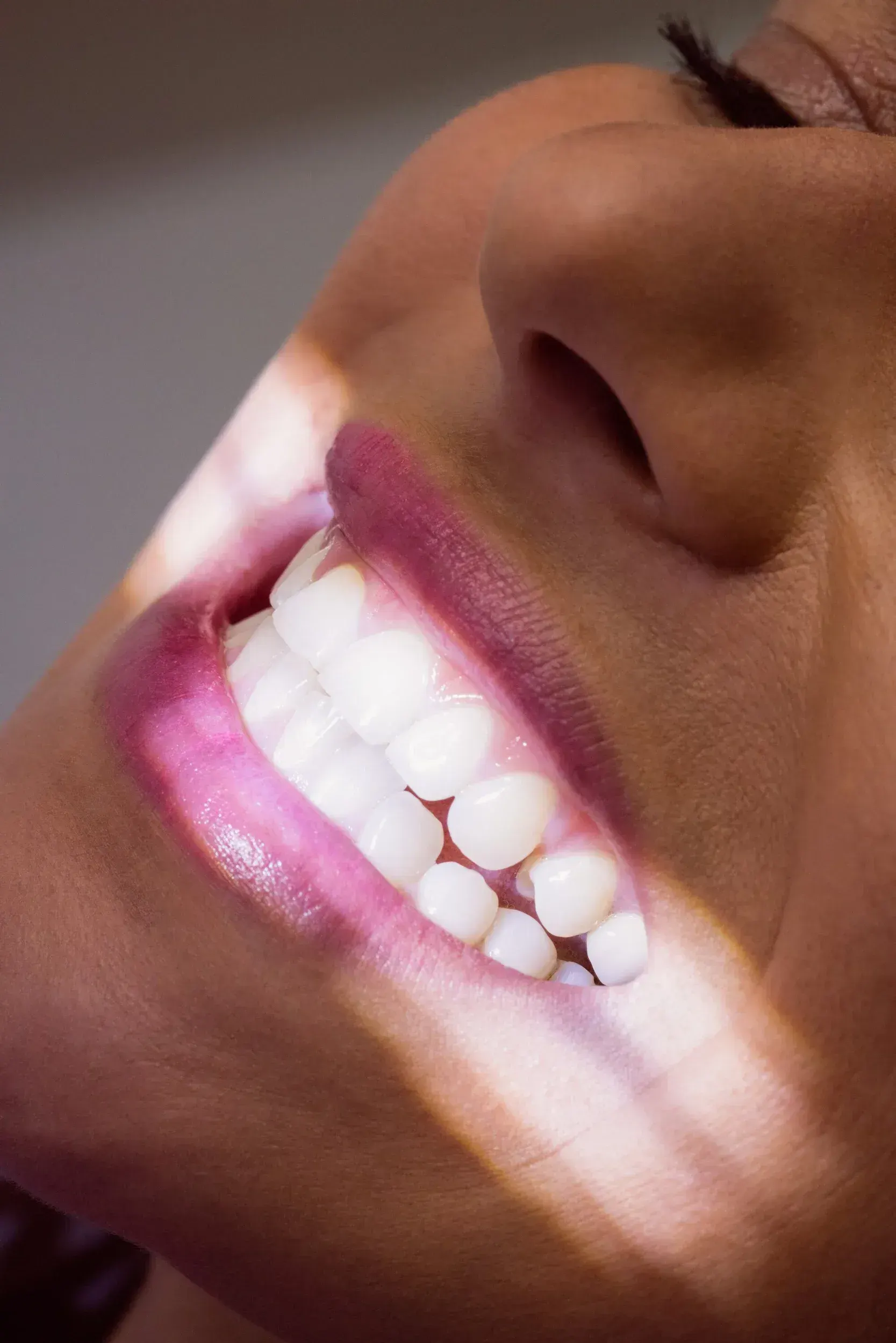 Who Is a Good Candidate for Dental Bridges?