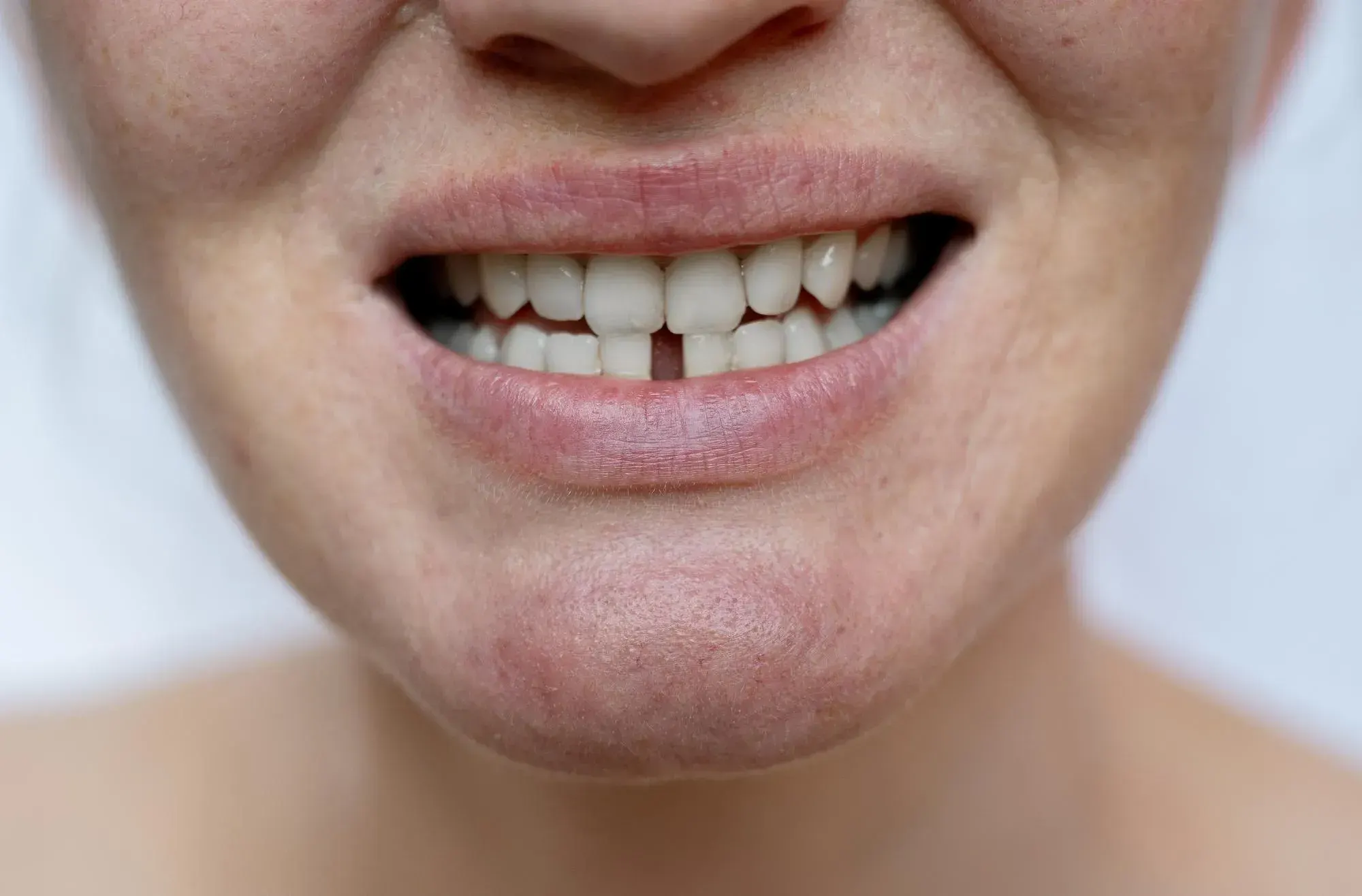 Illustration of jawbone resorption after tooth loss at East Ellijay Family & Cosmetic Dentistry Ellijay