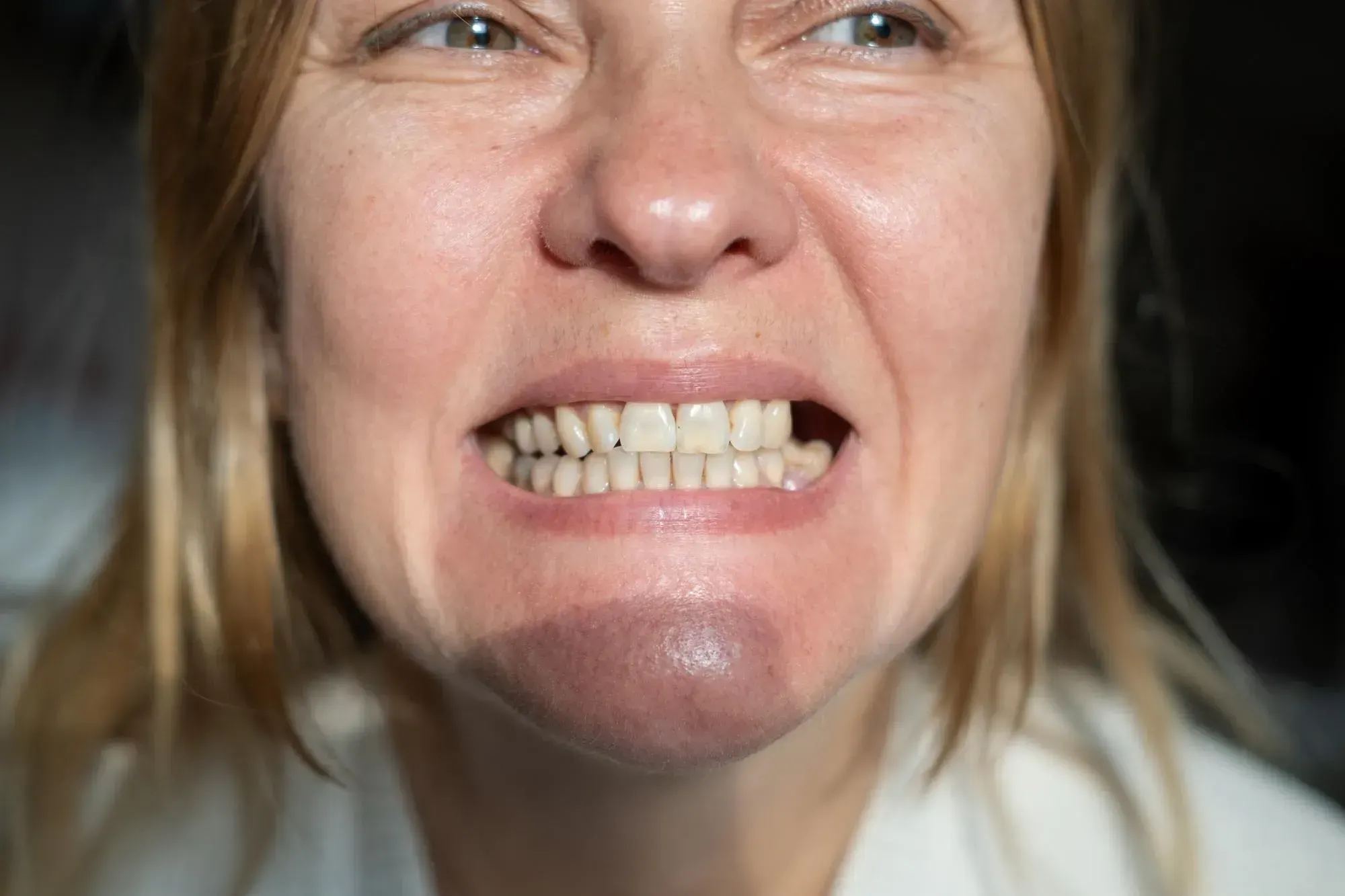 Close-up of a smile with a missing tooth at East Ellijay Family & Cosmetic Dentistry