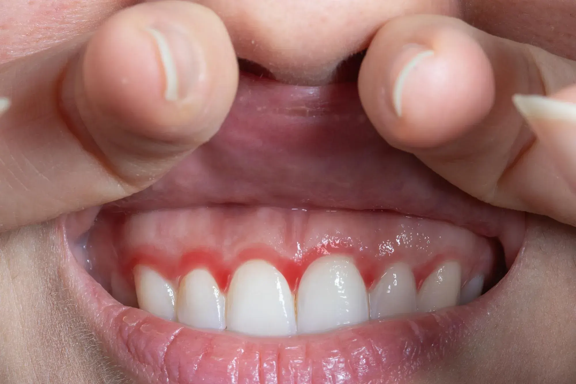 Patient describing tooth sensitivity symptoms at East Ellijay Family & Cosmetic Dentistry