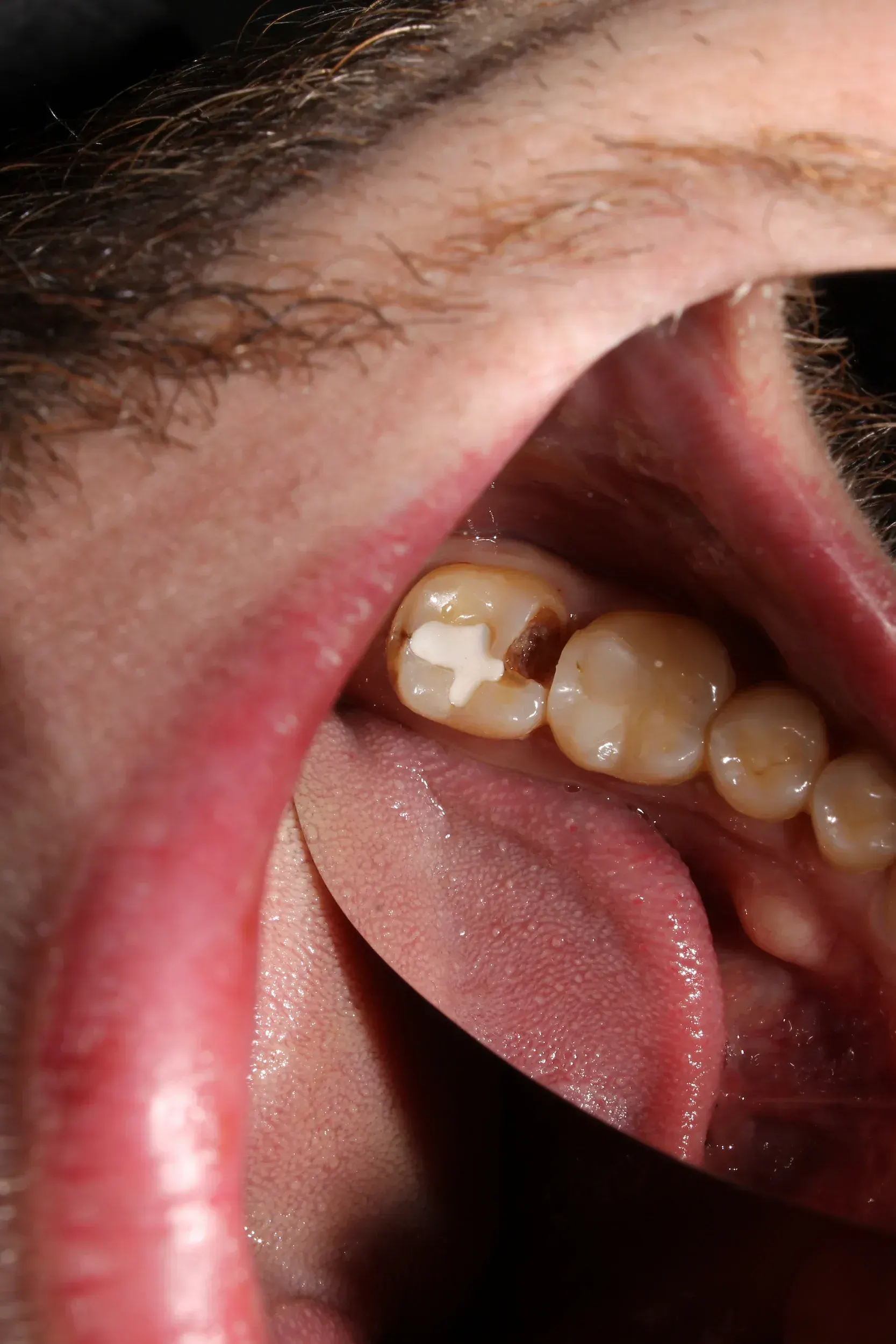 Close-up of a cracked molar at East Ellijay Family & Cosmetic Dentistry