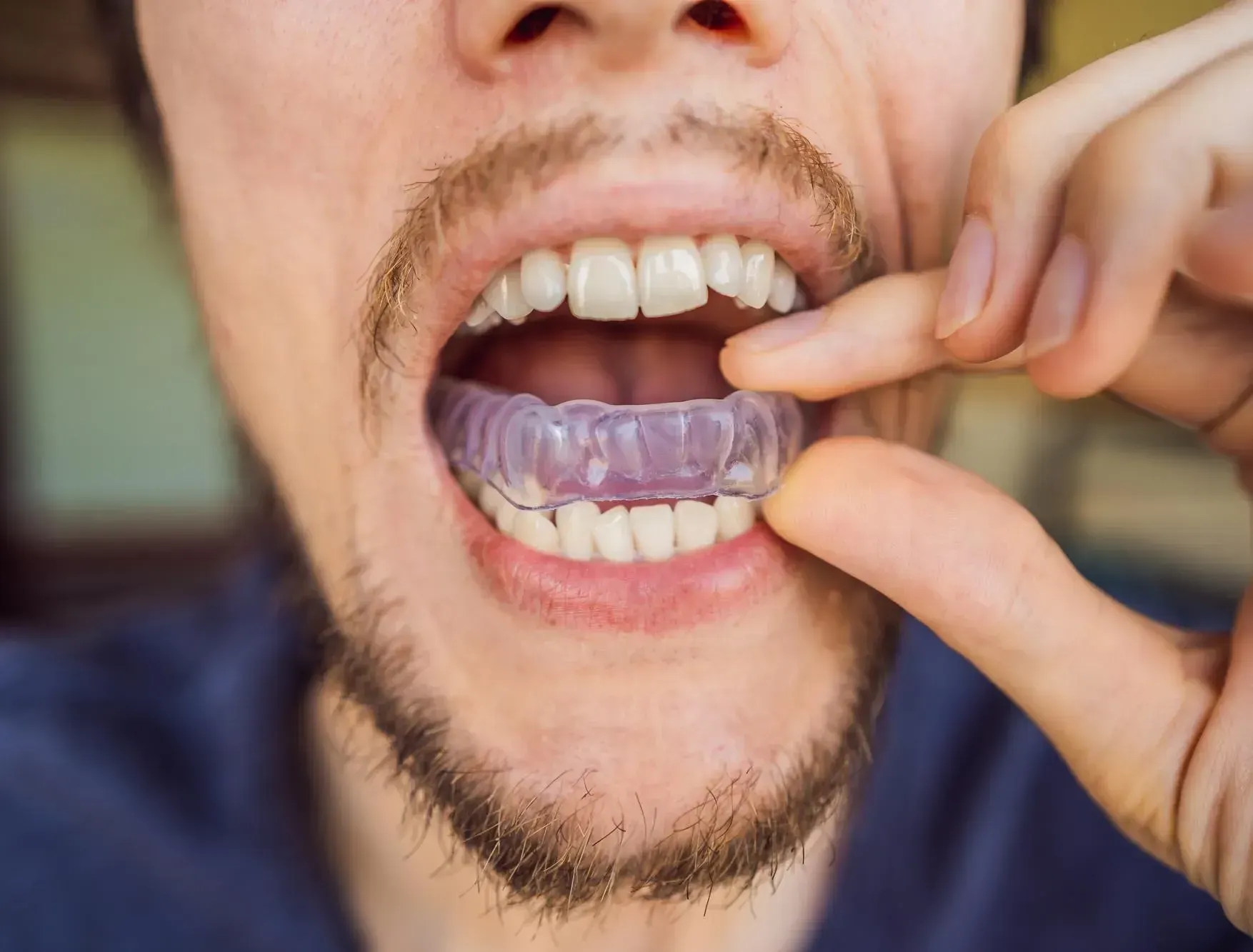 Worn molar with enamel loss illustrated at East Ellijay Family and Cosmetic Dentistry