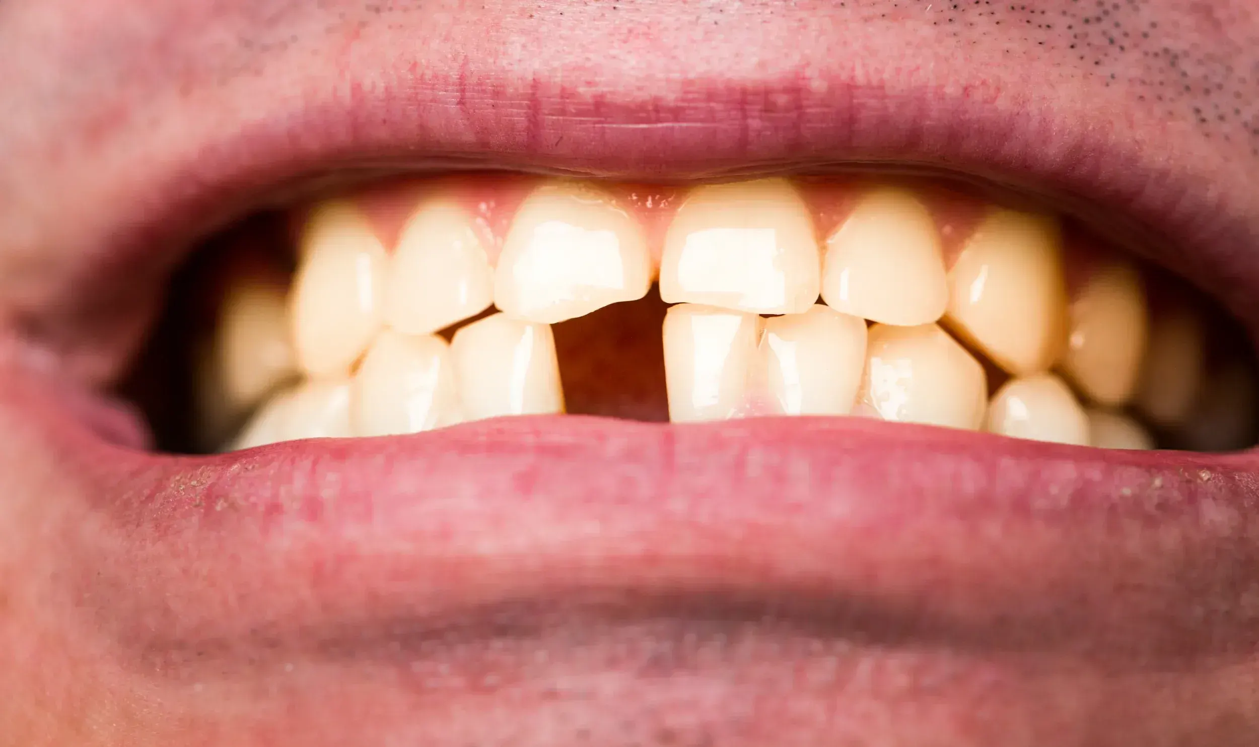 Patient receiving emergency broken tooth care at East Ellijay Family & Cosmetic Dentistry